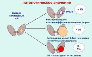 Узловой зоб щитовидной железы у взрослых. Клинические рекомендации