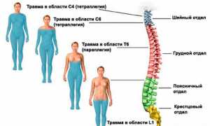Ушиб поясничного отдела позвоночника. Симптомы, лечение у взрослых