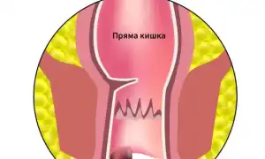 Как понять, что у тебя геморрой. Симптомы внутреннего геморроя, температура