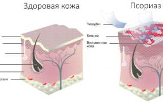 Эффективные таблетки от псориаза. Список, особенности применения, цены
