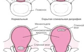 Спина бифида (spina bifida) S1 у взрослых. Лечение, что это значит