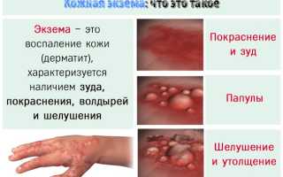 Красные прыщики на руках чешутся, на пальцах, выше локтя. Причины