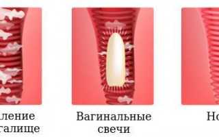 Свечи при вагините вагинальные, лучшие при беременности, эффективные