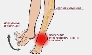 Невропатия (неврит) малоберцового нерва. Симптомы, лечение