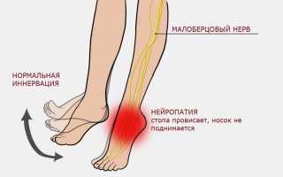 Невропатия (неврит) малоберцового нерва. Симптомы, лечение