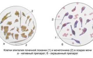 Эпителий плоский в моче повышен у женщин при беременности, ребенка, мужчин. Что это значит, причины, лечение