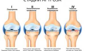 Деформирующий артроз (ДОА) коленного сустава 1-2 степени. Что это, лечение