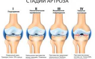 Деформирующий артроз (ДОА) коленного сустава 1-2 степени. Что это, лечение