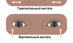 Нистагм глаз. Что это такое у взрослых, причины