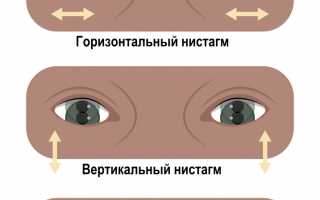 Нистагм глаз. Что это такое у взрослых, причины