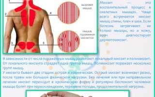 Миозит мышц руки. Симптомы и лечение, лекарства
