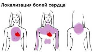 Невралгия в области сердца. Симптомы и лечение