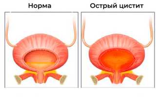 Моча оранжевого цвета у женщин. Причины, что это такое при беременности, цистите, ОРВИ, лечение