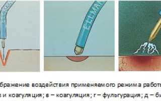 Радиоволновое удаление новообразований кожи, дефектов. Что это такое