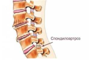 Спондилоартроз пояснично-крестцового отдела позвоночника. Лечение, что это, симптомы