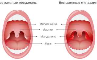 Белые штуки, налёт на гландах. Что это, как убрать