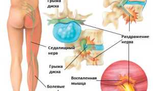 Боль в ягодице слева отдающая в ногу, справа. Что это, причины при сидении, ходьбе, вставании
