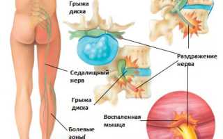Боль в ягодице слева отдающая в ногу, справа. Что это, причины при сидении, ходьбе, вставании
