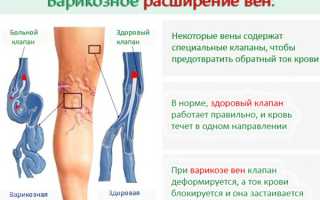 Хроническая венозная недостаточность. Классификация, лечение, степени