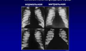 Митральная конфигурация сердца. Рентгенограмма, что это, характеристика