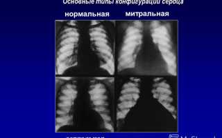 Митральная конфигурация сердца. Рентгенограмма, что это, характеристика