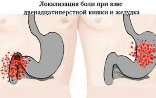Язва двенадцатиперстной кишки. Симптомы и лечение, причины. Народные средства, диета, препараты