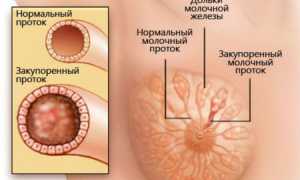 Галактоцеле молочной железы. Что это такое, лечение
