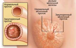 Галактоцеле молочной железы. Что это такое, лечение