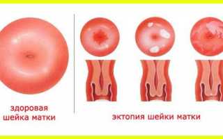 Псевдоэрозия шейки матки. Что это такое, симптомы, лечение