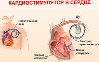 Кардиостимулятор. Что это такое, виды, как работает, сколько стоит, операция по установке, жизнь с ним