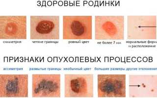 Удаление родинок лазером. Цена, отзывы