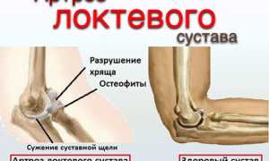 Остеоартроз локтевого сустава у женщин. Что это, лечение