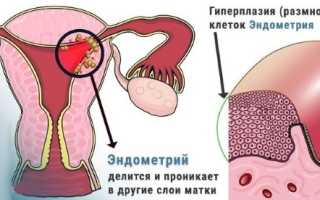 ГПЭ в гинекологии. Что это такое, симптомы, лечение гормонами, народными средствами, причины, последствия