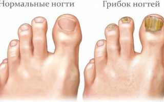 Фундизол от грибка ногтей. Инструкция по применению, цена, аналоги, отзывы