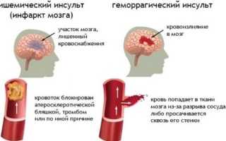 Инфаркт головного мозга и инсульт. Разница и отличия