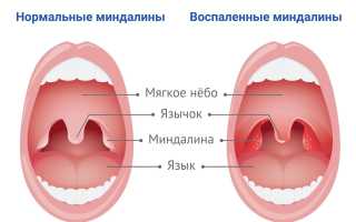 Воспаление миндалин: фото, симптомы и лечение у детей и взрослых, чем полоскать горло