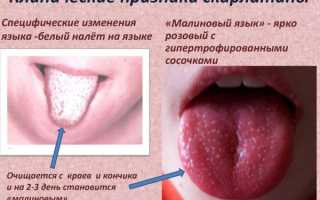 Симптомы и лечение скарлатины у детей, как выглядит горло, язык, сыпь. Стадии, профилактика, инкубационный период, последствия