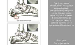 Лечение пяточной шпоры Витафоном. Инструкция, отзывы