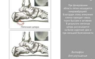 Лечение пяточной шпоры Витафоном. Инструкция, отзывы