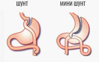Шунтирование желудка. Что это такое, цена, отзывы при похудении