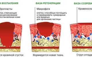 Лечение ожоговых ран, волдырей, солнечный, термический, химический, кипятком. Первая помощь, препараты, процедуры, народные средства