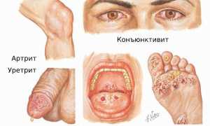 Синдром Рейтера. Симптомы, что это за болезнь, лечение