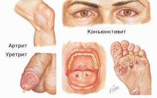 Синдром Рейтера. Симптомы, что это за болезнь, лечение