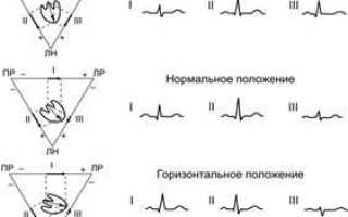 Угол альфа (α, ЭОС, электрическая ось сердца) на ЭКГ. Норма у взрослых, детей, как определить