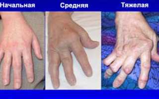 Остеоартроз кистей рук. Лечение, причины, степени