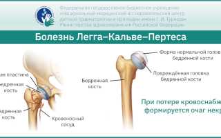 Болезни тазобедренного сустава у женщин. Симптомы, первые признаки, лечение, причины
