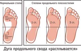 Плоскостопие 2 степени: категория годности в армию, лечение
