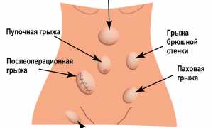 Виды грыж живота, позвоночника, межпозвоночных, паховых