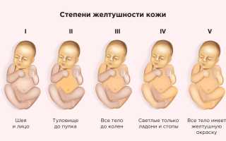Желтушка у новорожденных. Причины и последствия, норма билирубина, лечение, чем опасна, сколько длится, когда проходит