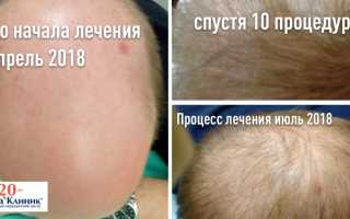 Лечение волос от выпадения народными средствами, эффективными препаратами, косметическими процедурами